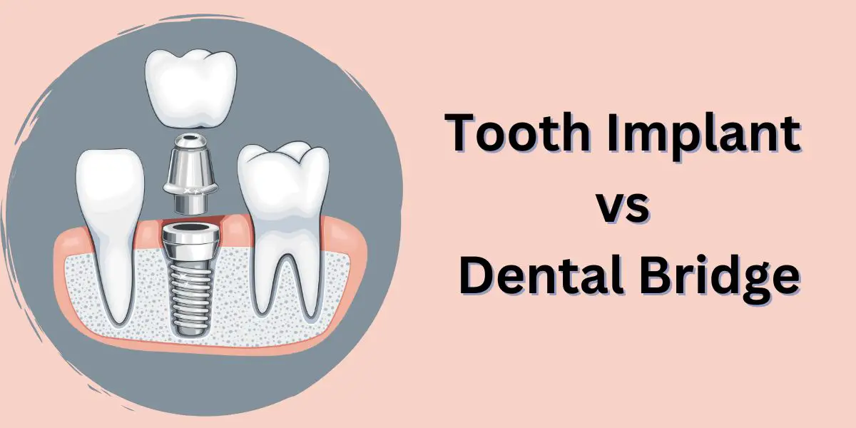 Tooth Implant vs Dental Bridge: Which is Better for You?